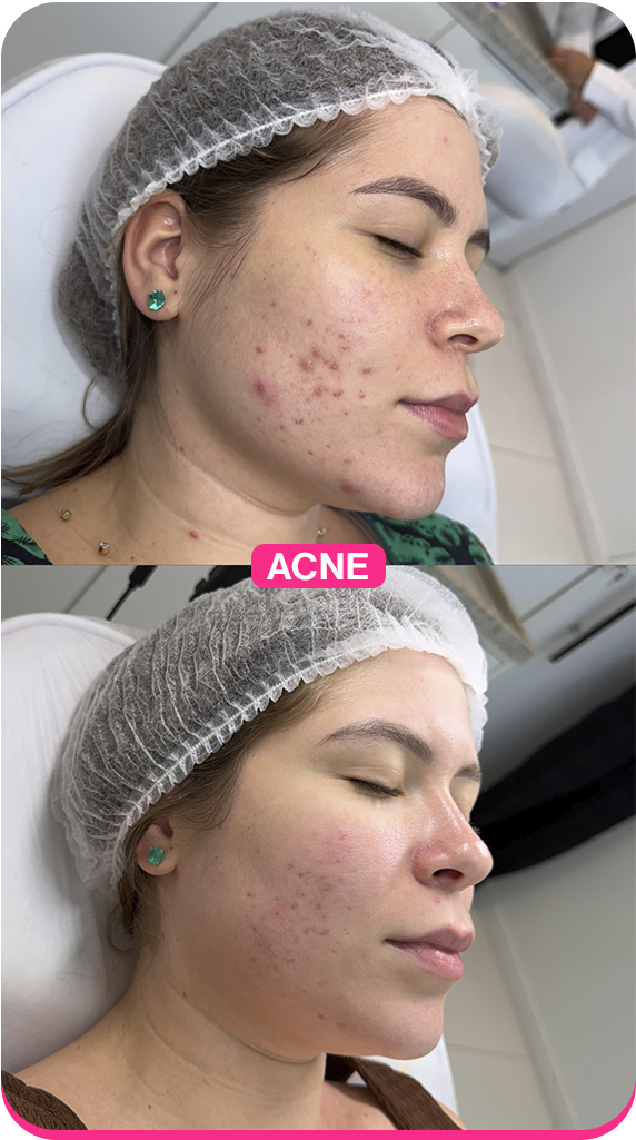 Acne