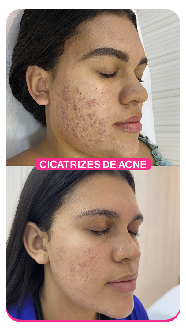 Cicatrizes de Acne