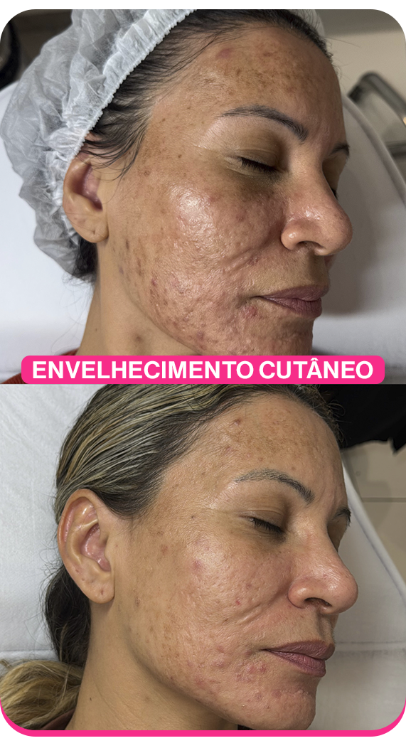 Envelhecimento cutâneo