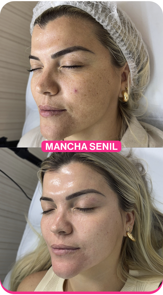Mancha Senil