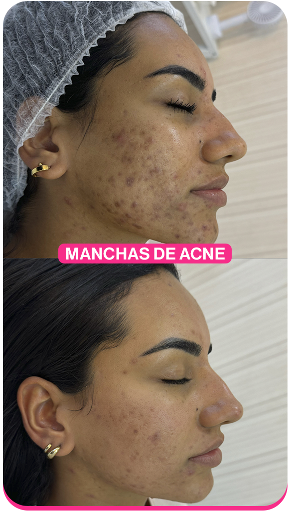 Manchas de Acne