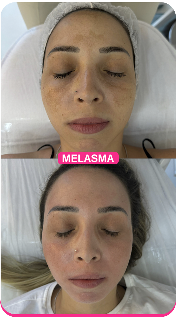 Melasma