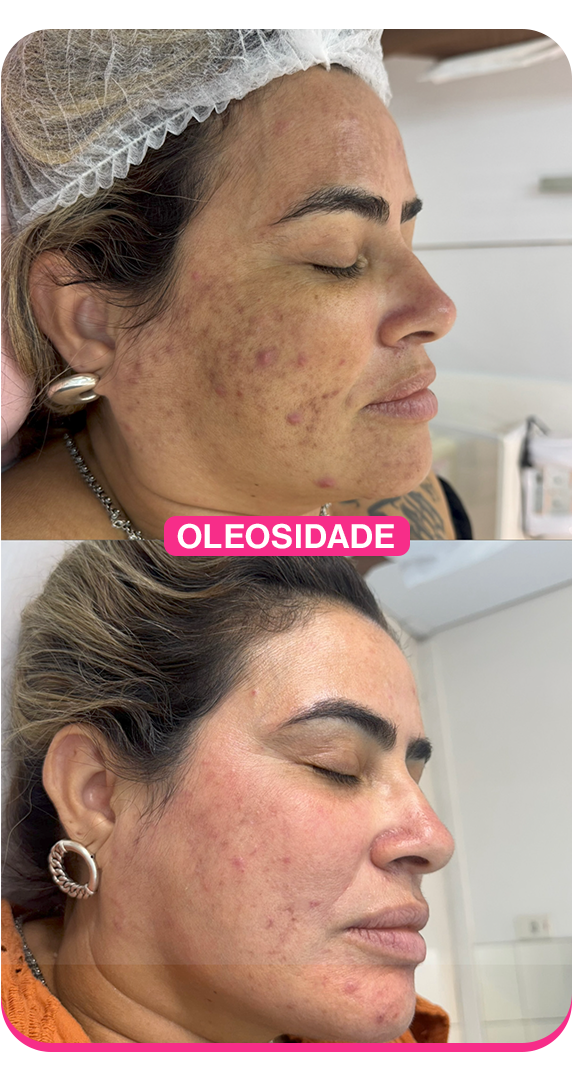 Oleosidade