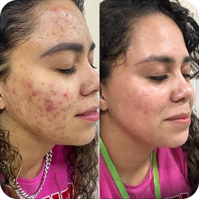 Resultado-Yuri-acne-1.webp